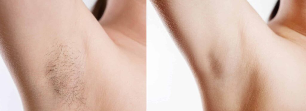 Arm Hair Removal