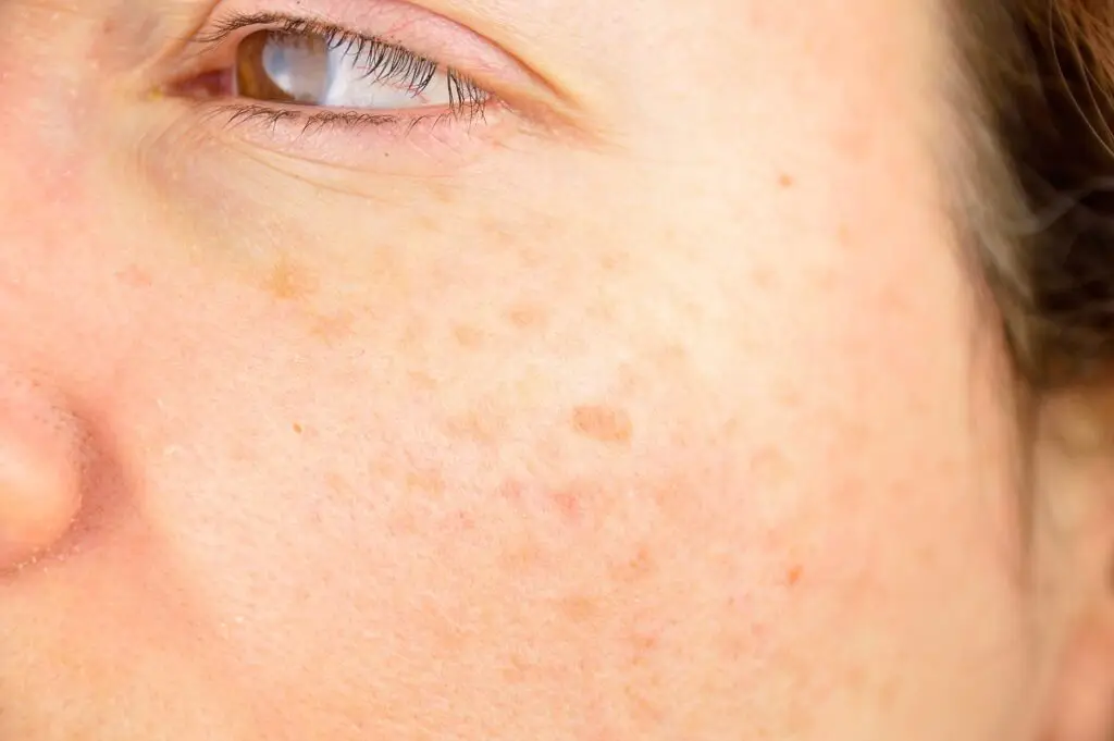 Close-up of sun spots and freckles on summer-stressed facial skin