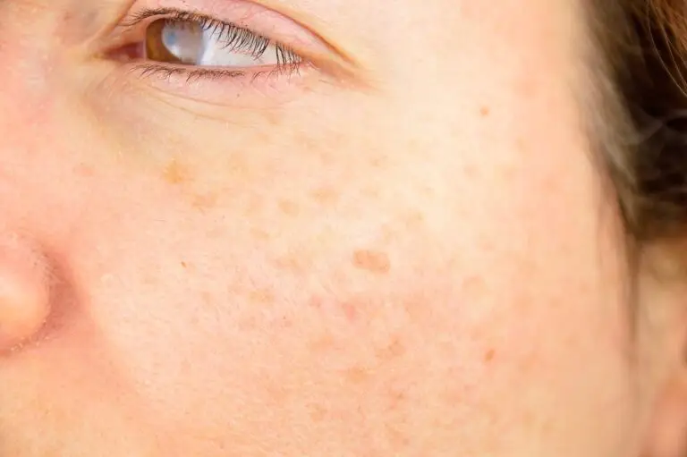 Close-up of sun spots and freckles on summer-stressed facial skin